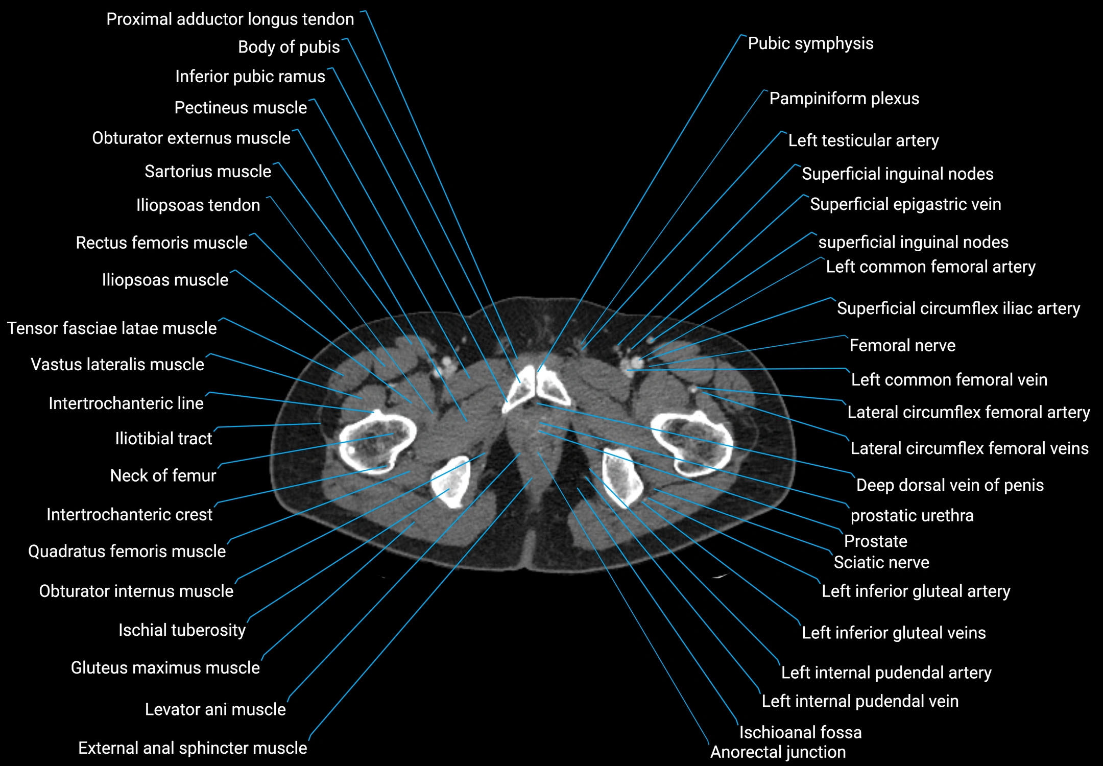 CT male pelvis axial cross sectional anatomy labelled radiology image -00203.webp